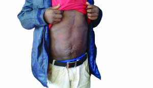 •DANIEL Chisenga shows how his stomach looks after a successful operationin Italy.