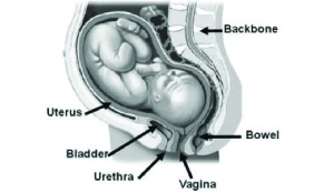 • women who bear children before their pelvis is fully developed risk having their pelvic tissues damaged.