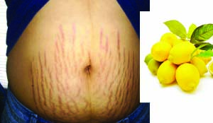 • consuming protein, zinc and Vitamin C rich foods in abundance, green salad, milk, fish, nuts and citrus fruits help a lot in diminishing stretch marks.