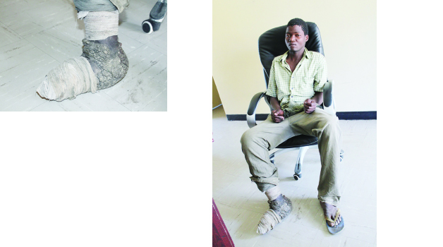 •GIVEN Phiri, the 19-year-old boy suffering from a fungal infection on his right leg suspected to be elephantiasis. Picture by CHILA NAMAIKO
